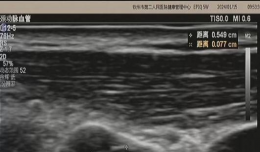 【欽二醫(yī)技術(shù)】小微泡大作用 頸動(dòng)脈超聲造影——透視血管的另一只“眼”
