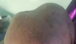 【欽二醫(yī)生說】寶寶的小腦袋長成了“犄角”怎么辦